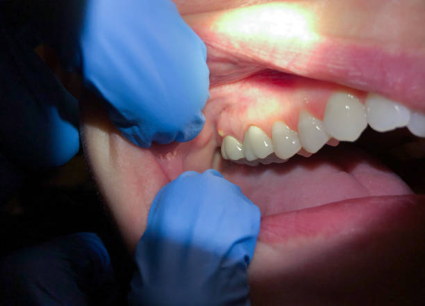 Best Emergency Root Canal Treatment in Luling, LA