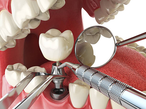Best Urgent Care for Lost Fillings or Crowns in Luling, LA